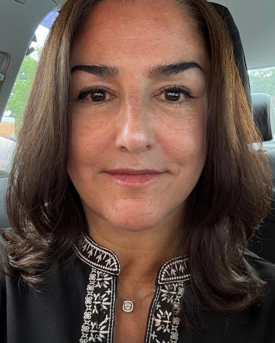 Before &mdash; Deep Plane Face Lift in Mexico City
